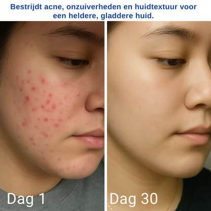 Excellent A313 Huidverjonging